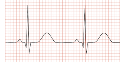 Världens första pacemaker med internetuppkoppling